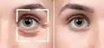 Elimine as rugas de expressão dos olhos (Foto: Freepik/ Reprodução)