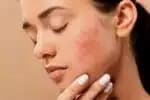 Saiba quais cuidados tomar para vencer de vez a acne feminina! Foto: Reprodução 