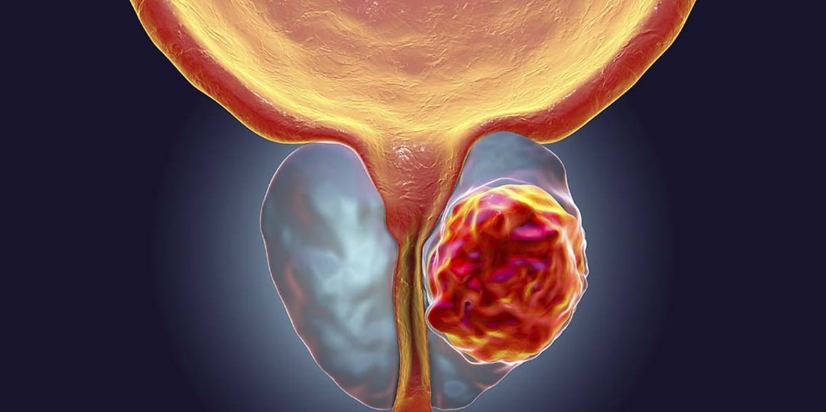 Imagem ilustrativa do câncer de próstata (Foto: Reprodução/ Freepik/ Montagem)