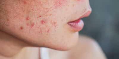 Confira 8 dicas caseiras para ajudar a eliminar as manchas de acne no rosto